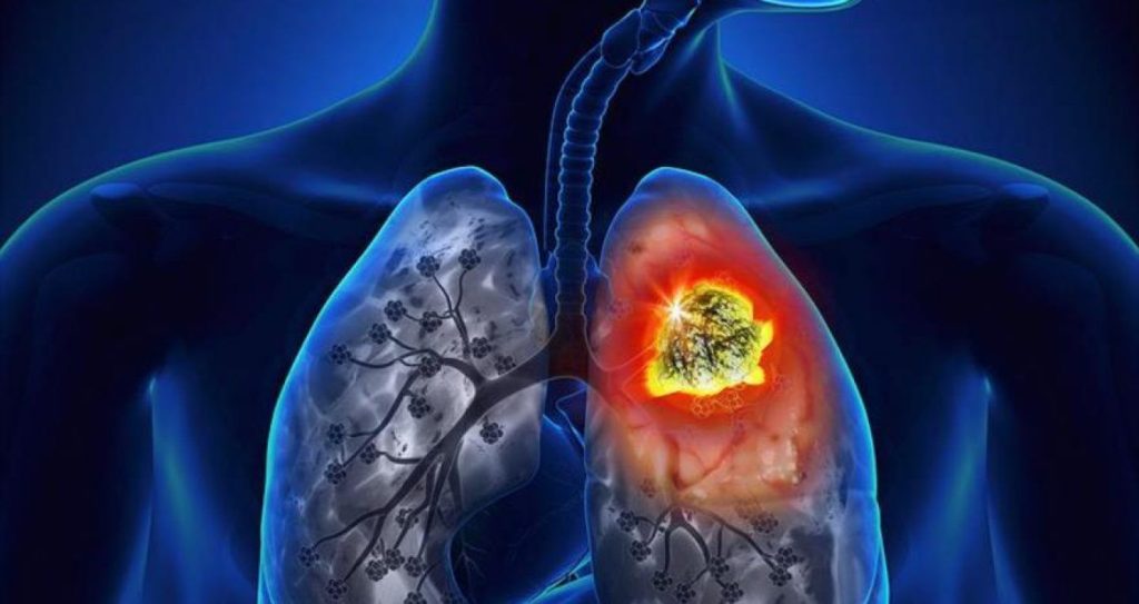 Asbestosis: Síntomas, causas y tratamiento de esta grave enfermedad