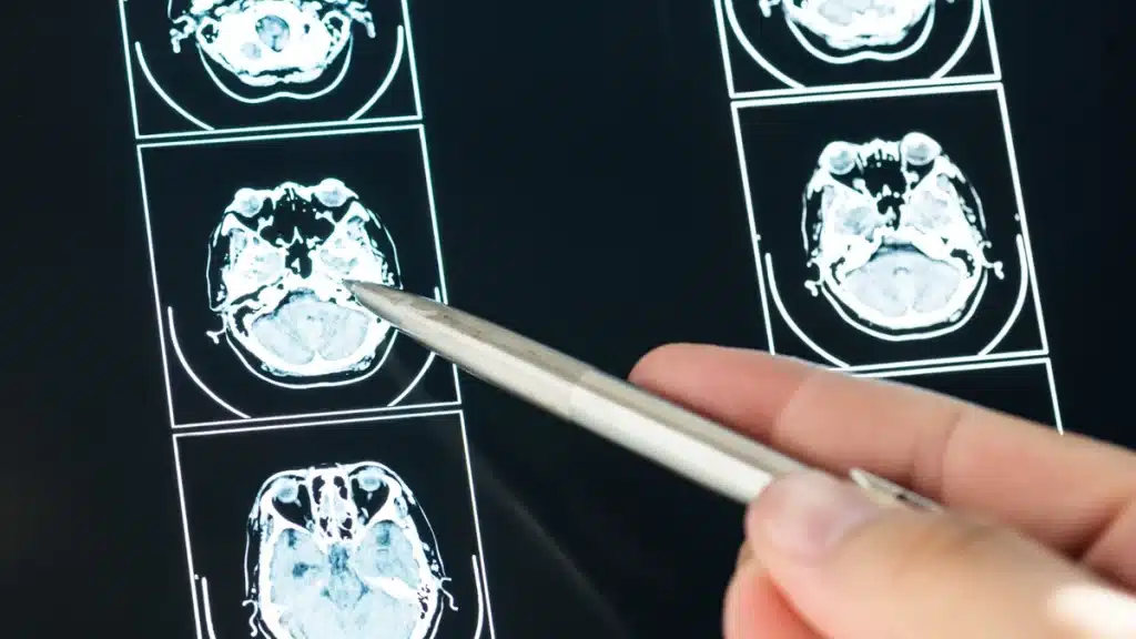 Investigadores crean un bolígrafo con IA capaz de detectar el Parkinson al escribir